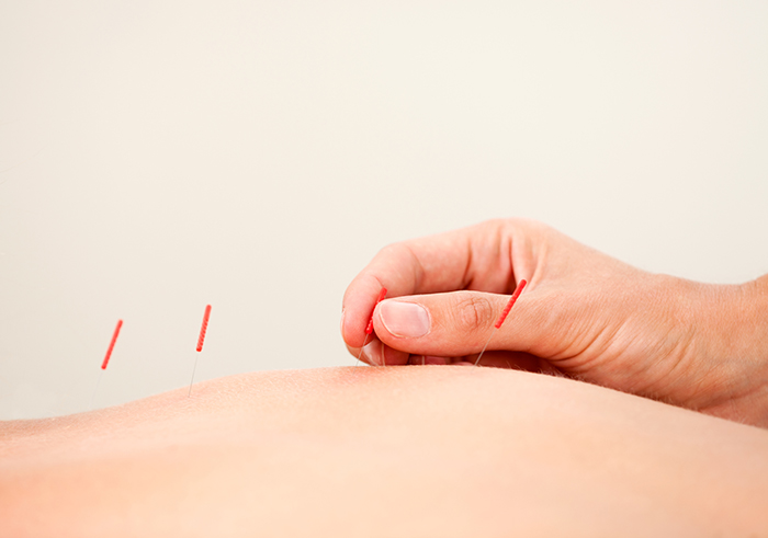 Akupunktur nadel in Schulter